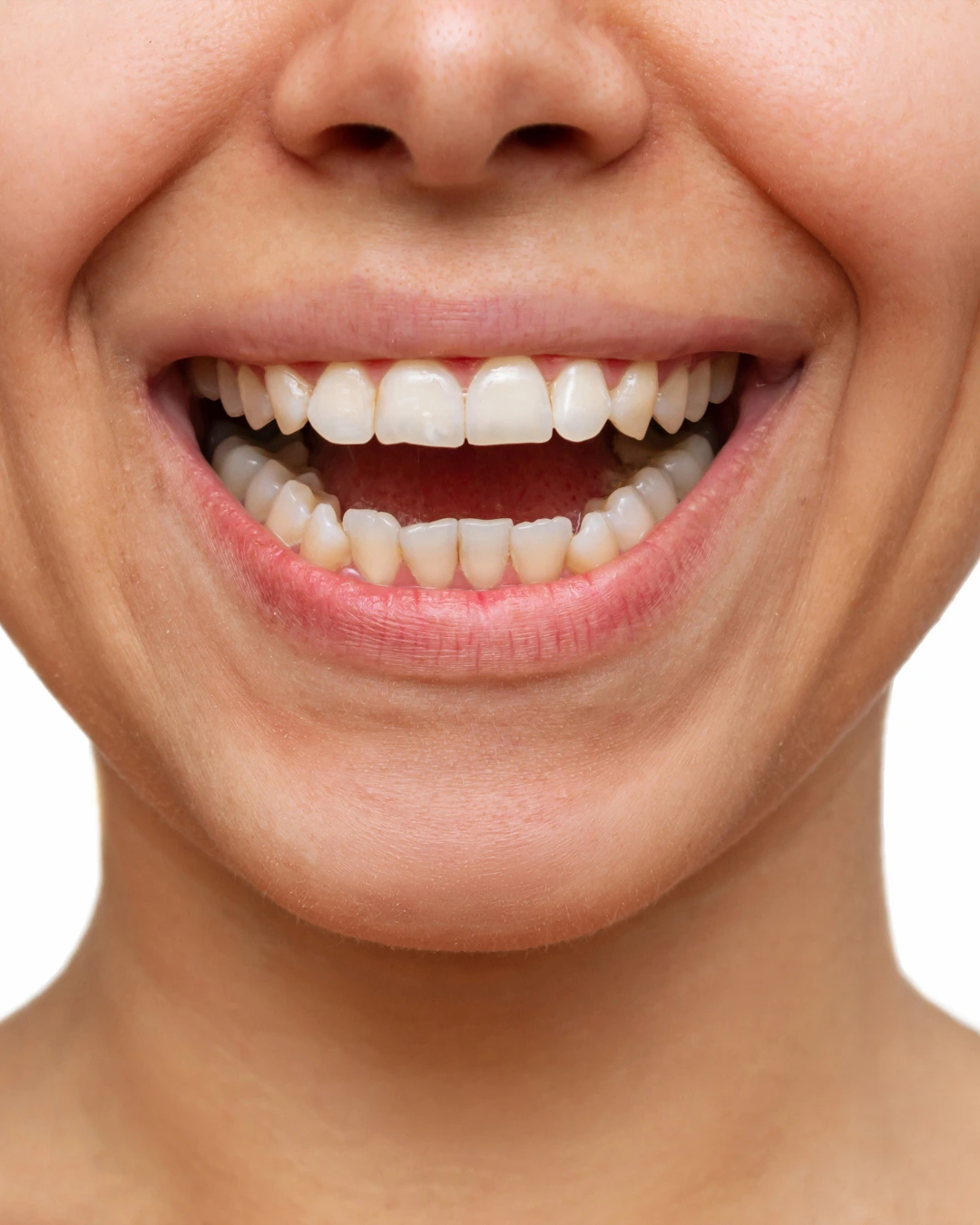 Dental Veneers Before
